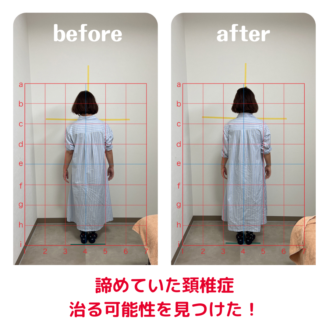 諦めていた頚椎症治る可能性を見つけた!
