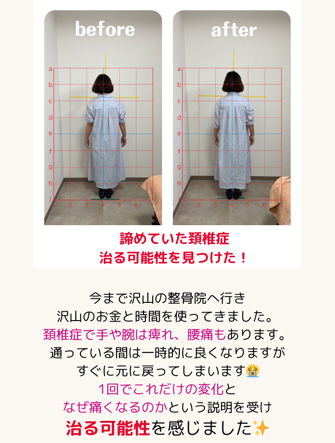 お客さまの声4:諦めていた頚椎症、治る可能性を見つけた！